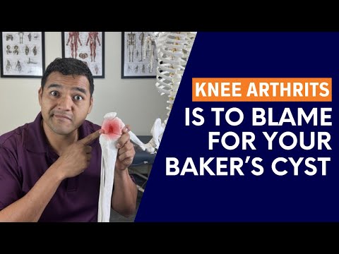 The Hidden Link Between Knee Arthritis and Baker’s Cyst [Video]