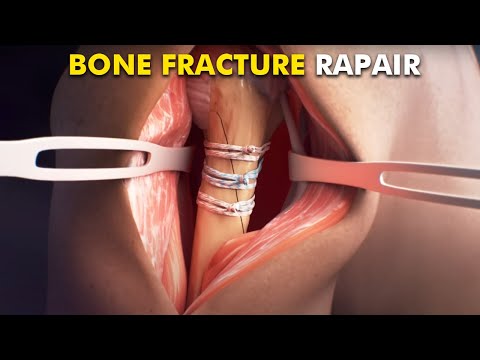 Bone Fracture Healing Explained: Types, Non-Surgical & Surgical Repair Methods [Video]