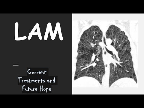 Living with LAM: Current TREATMENT and Future HOPE #rarelungdisease #women’shealth [Video]