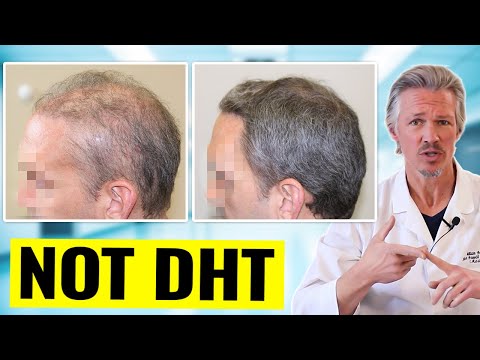 INFLAMMATORY HAIR LOSS 90 DAY RESULTS! SEE WHAT CAN HAPPEN WHEN YOU TREAT THE CAUSE CORRECTLY [Video]