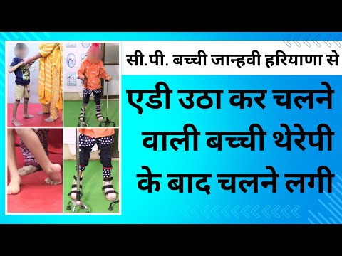 Child with Cerebral Palsy from Haryana is independently walking at Trishla Foundation in Prayagraj. [Video]