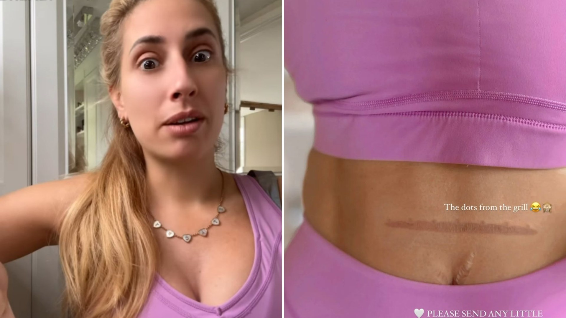 Stacey Solomon reveals huge burn on her stomach after accident in her gym gear [Video]