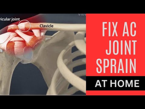 Fix Acromioclavicular joint(ACJ) sprain at home with stretches and exercises [Video]