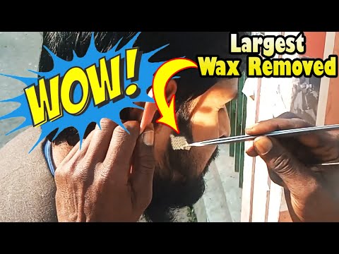 [Infected] White Ear Plugs Removal / Absolutely I’m Fully Relief & Got Refreshed-Happy to Work with [Video]