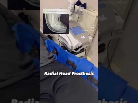 🦾 Radial head prosthesis with Winback Therapy 👏 [Video]