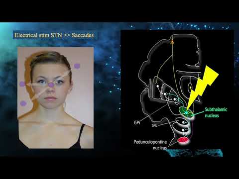Non-Invasive Method of STN Stimulation In The Neurorehabilitation of Parkinson’s Disease. [Video]