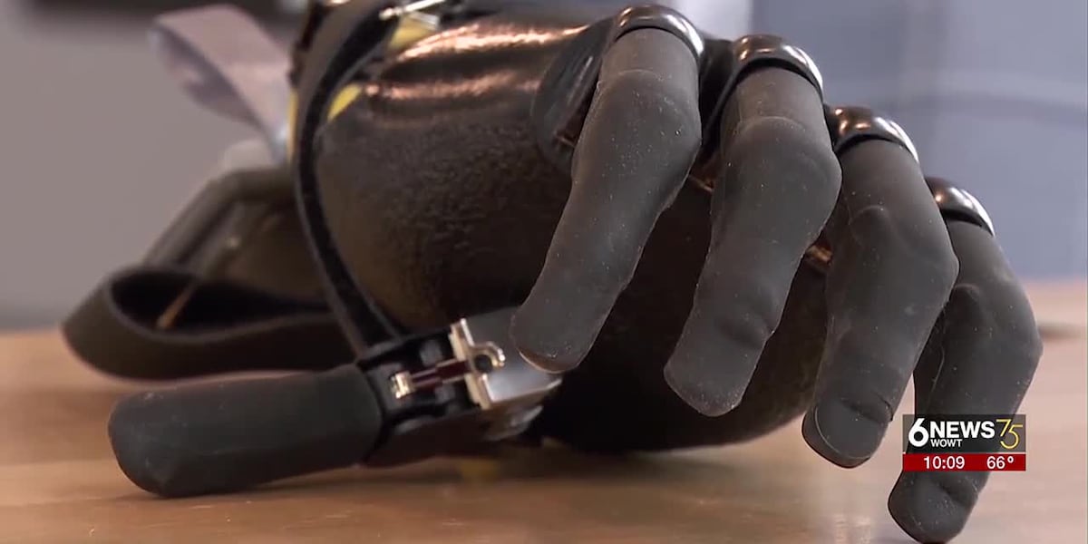 Technology helping Council Bluffs man who lost fingers gain independence [Video]