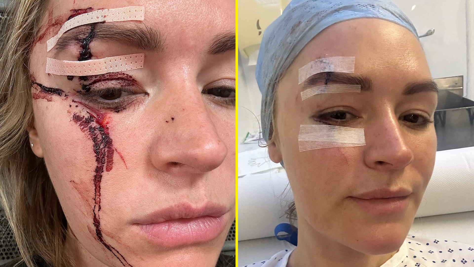Laura Woods pulls out of hosting Tyson Fury vs Oleksandr Usyk after suffering horrific facial injury in freak accident [Video]