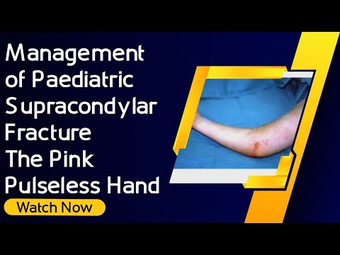 Management of Paediatric Supracondylar Fracture – The Pink Pulseless Hand [Video]