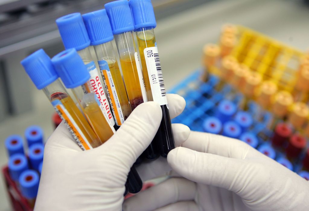Blood Test Identifies Immune Response in Multiple Sclerosis Patients, Paves Way for New Treatments [Video]