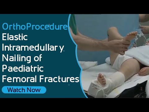 OrthoProcedure – Elastic Intramedullary Nailing of Paediatric Femoral Fractures [Video]