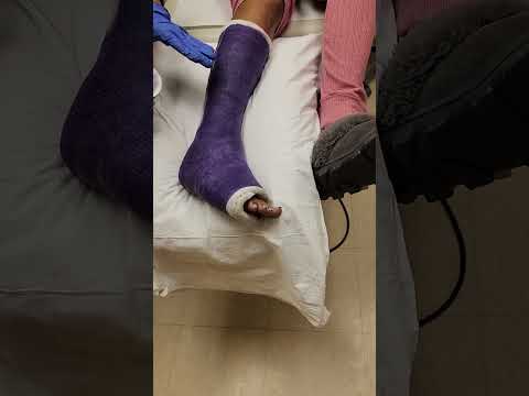 Removing Leg Foot Cast with Cast Saw (Jones Fracture) [Video]