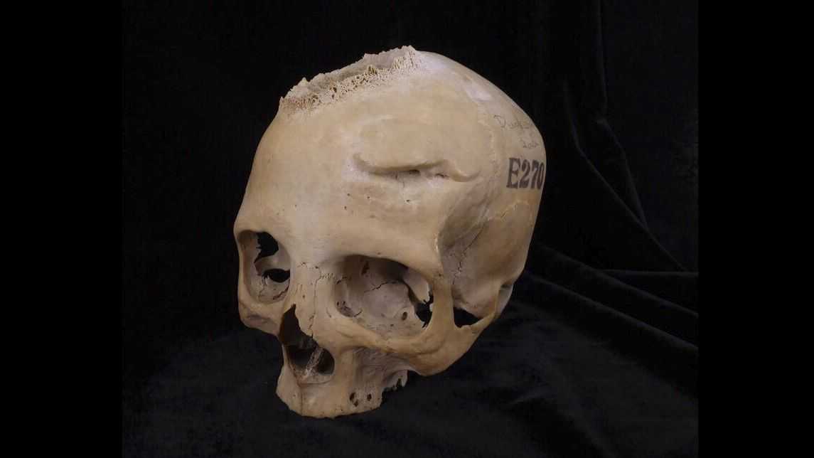 Evidence of surgical tumor removal in ancient Egyptian skull [Video]