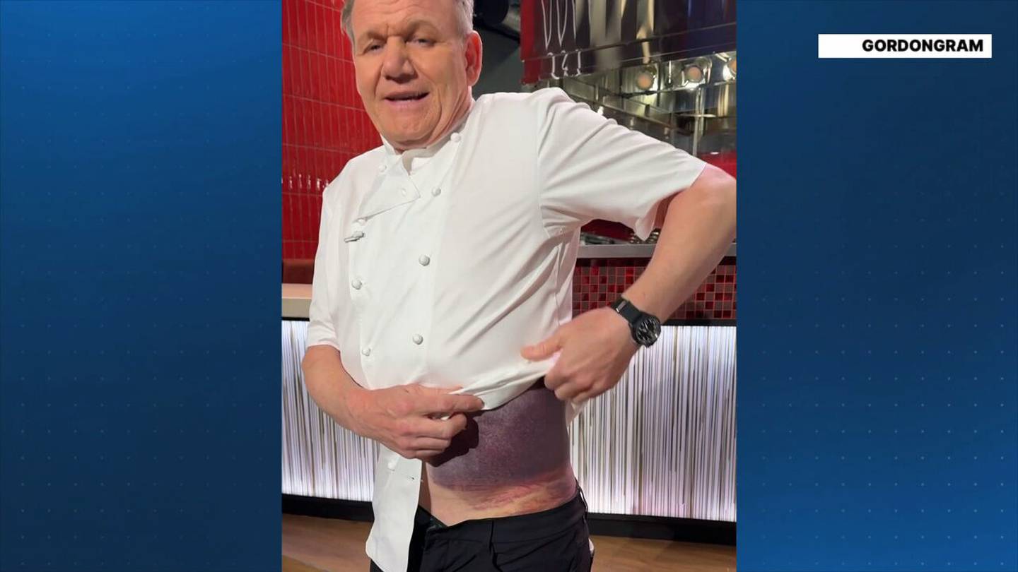 Chef Gordon Ramsay shows off nasty injury he suffered in New England accident  Boston 25 News [Video]