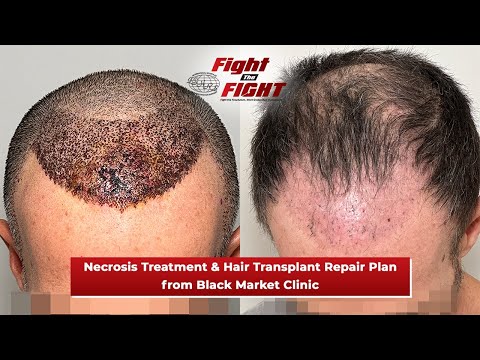 FOURTH ANNUAL “WORLD HAIR TRANSPLANT REPAIR DAY” AIMS TO EDUCATE, ASSIST VICTIMS OF FRAUDULENT, ILLICIT HAIR TRANSPLANT CLINICS [Video]