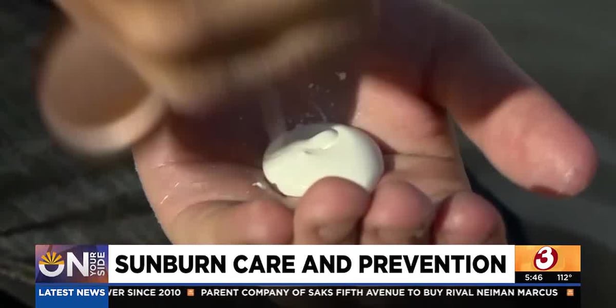 What to know about sunburn care and prevention [Video]